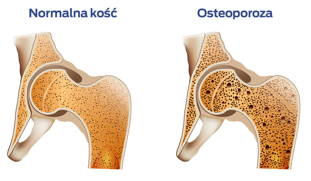Osteoporoza kości